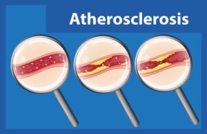 what is atherosclerosis